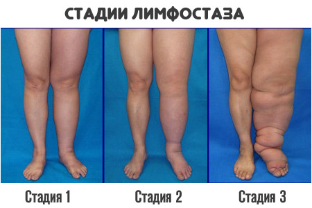 стадии-лимфедемы
