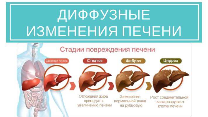 Диффузные изменения печени. Причина. Симптомы. Как избавиться? Недостаточно просто пить гепатопротекторы при диффузных изменениях печени. Есть более комплексный натуральный подход через детокс, нормализацию микрофлоры и оксидативный стресс. Это поможет избавиться от диффузных изменений за 3-4 месяца на фоне правильного питания.
