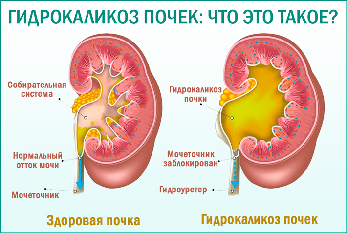 Гидрокаликоз почек: что это такое? Что такое гидрокаликоз почек?