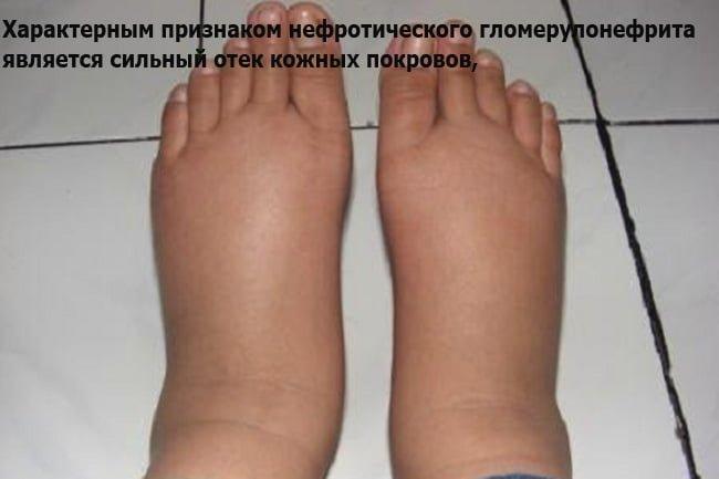 Отеки при гломерулонефрите