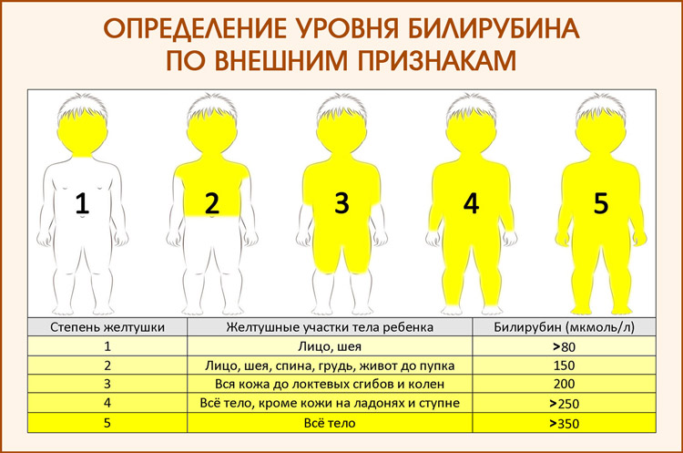 Определение уровня билирубина по внешним признакам Определение уровня билирубина у новорожденных