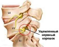 Корешковый синдром Корешковый синдром