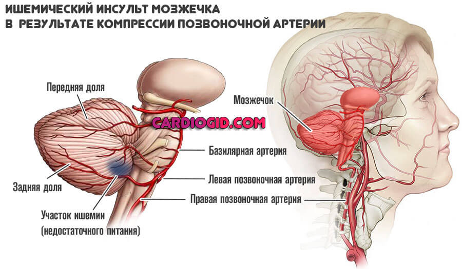 ишемия-мозжечка-в-результате-СПА