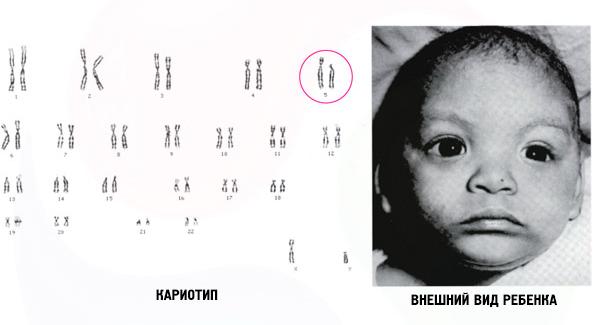 Кариотип и внешний вид ребёнка при синдроме кошачьего крика Кариотип и внешний вид ребёнка при синдроме кошачьего крика