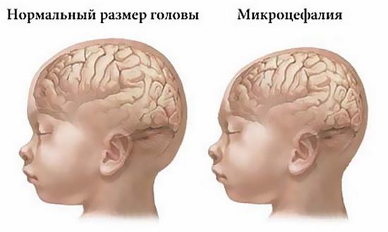 Нормальный размер головы и патологический Нормальный размер головы и патологический
