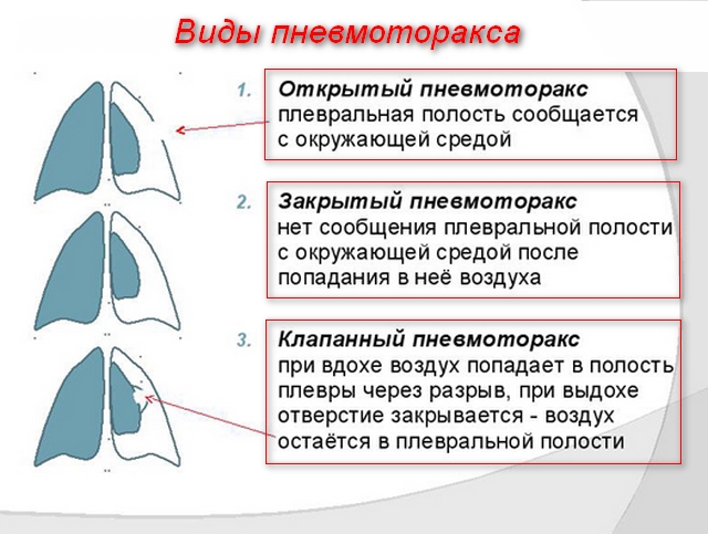 Ранение грудной клетки код мкб