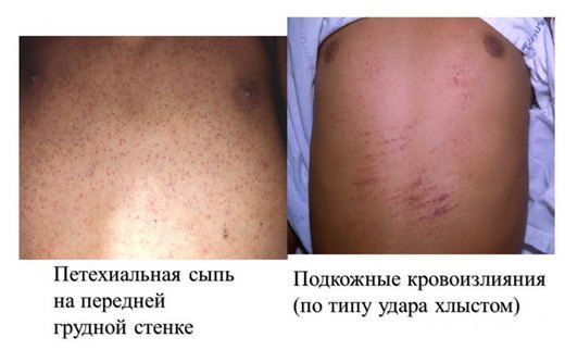 Проявления геморрагического синдрома Проявления геморрагического синдрома