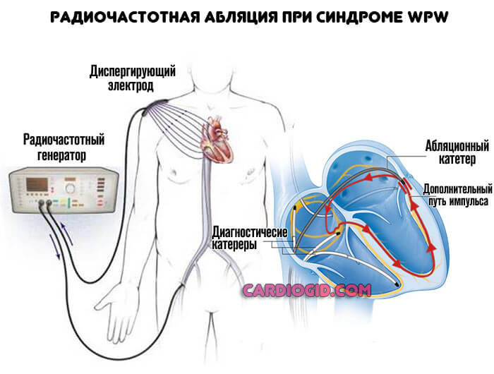 радиочастотная-абляция-при-синдроме-wpw