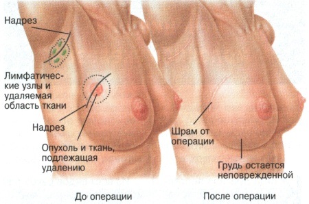 Операция пр раке молочной железы