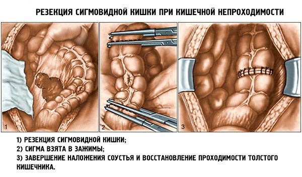 Резекция при острой кишечной непроходимости Резекция при острой кишечной непроходимости