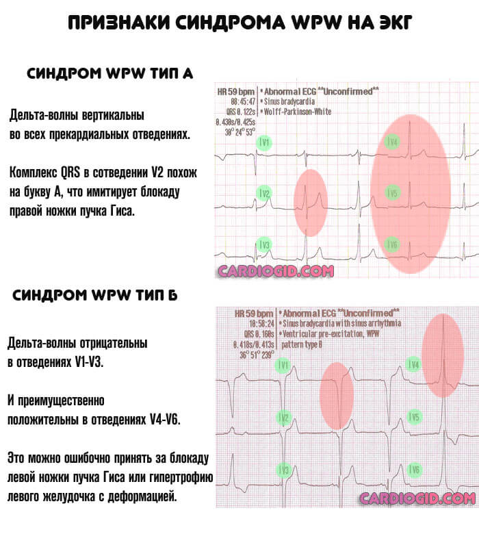 синдром-впв-на-экг