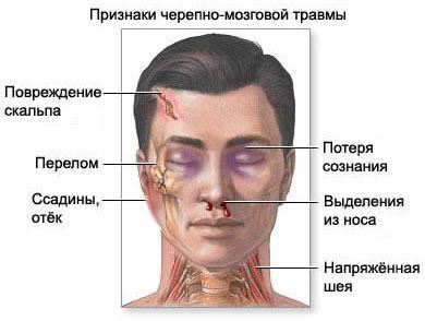 Симптомы сотрясения головного мозга